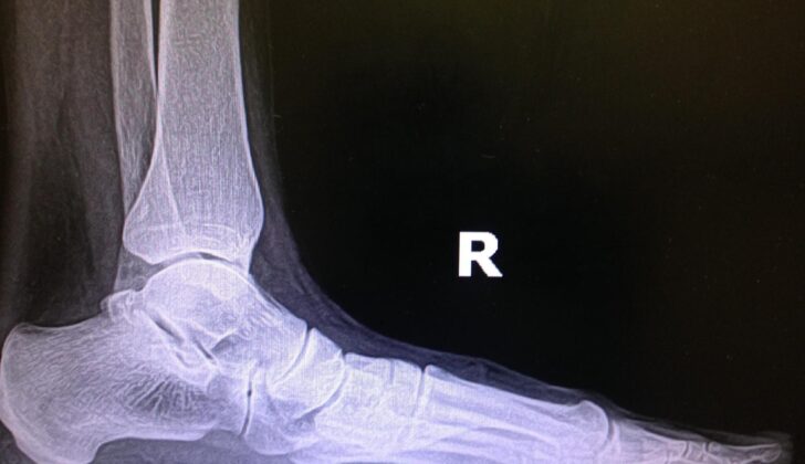 Pes Planus Note the lack of the longitudinal arch, increased talar declination, and decreased calcaneal pitch.