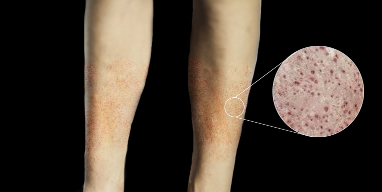 Petechiae. Close-up image showing petechiae scattered over the legs.