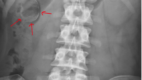 Porcelain gallbladder