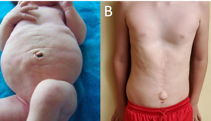Prune belly syndrome - A. At birth B. At nine years of age (surgical scars noted from a prior abdominoplasty procedure)