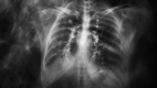 Pulmonary Eosinophilia