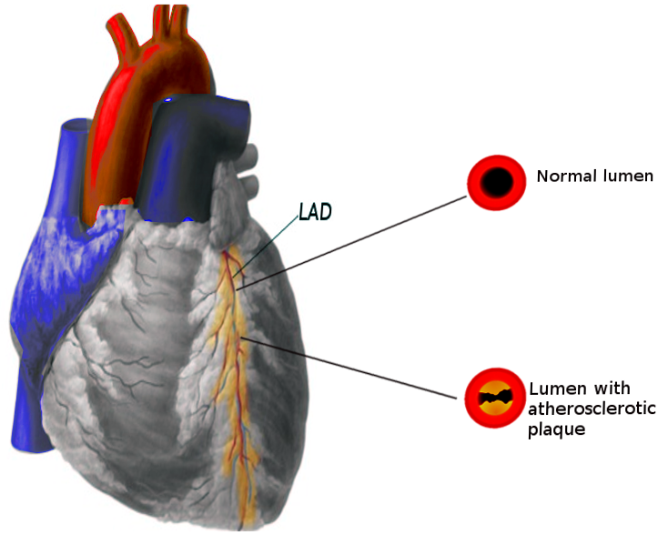 Coronary Artery Disease Pathophysiology. Coronary artery disease is usually
caused by an atherosclerotic plaque that blocks the lumen of a coronary artery,
typically the left anterior descending artery.