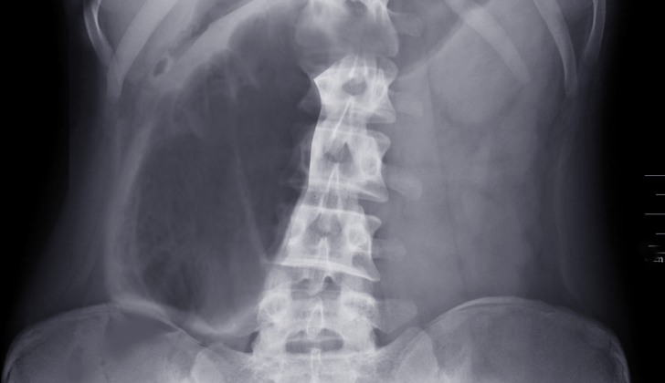 Cecal Volvulus. Cecal volvulus is torsion of the cecum around its mesentery, which often results in obstruction. 