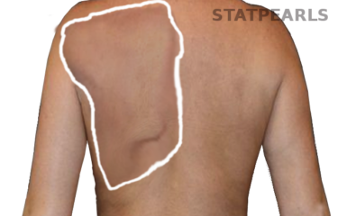Winging of scapula