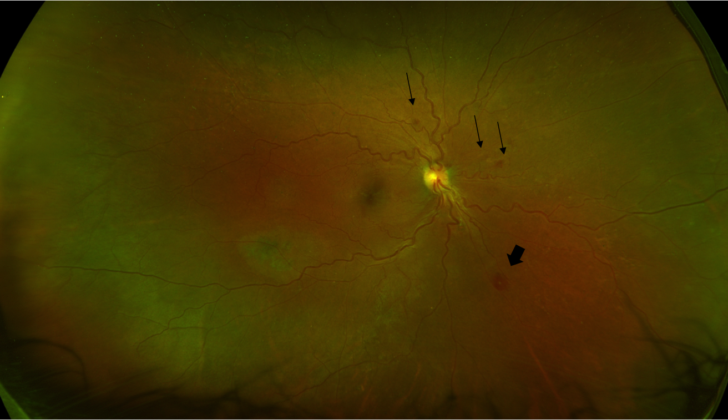 Retinal photograph of a patient with candidemia showing multiple retinal hemorrhages (arrows) and a Roth spot (arrow-head).