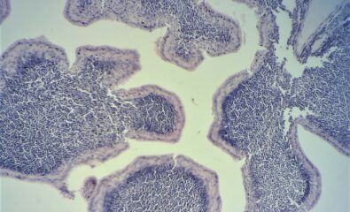 Warthin Tumor. A warthin tumor is composed of papillary structures lined by oncocytic epithelial cells. The core of the papillae is occupied by dense lymphoid aggregates (hematoxylin and eosin ×200).