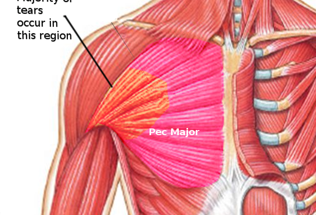 Pectoralis Major tears