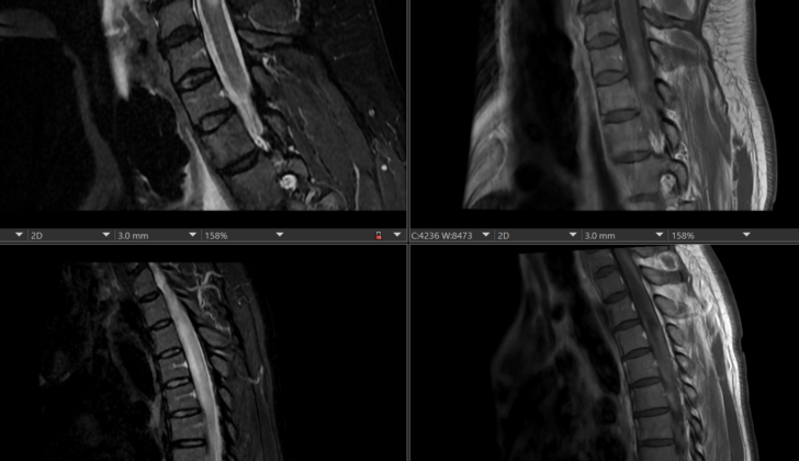 Neuromyelitis Optica. MRI showing inflammation of the spinal column, a common aspect of neuromyelitis optica.