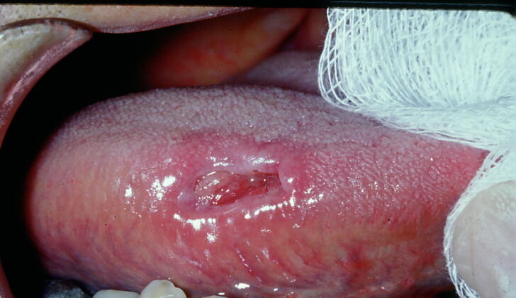 Traumatic ulcerative granuloma with stromal eosinophilia located on the tongue.