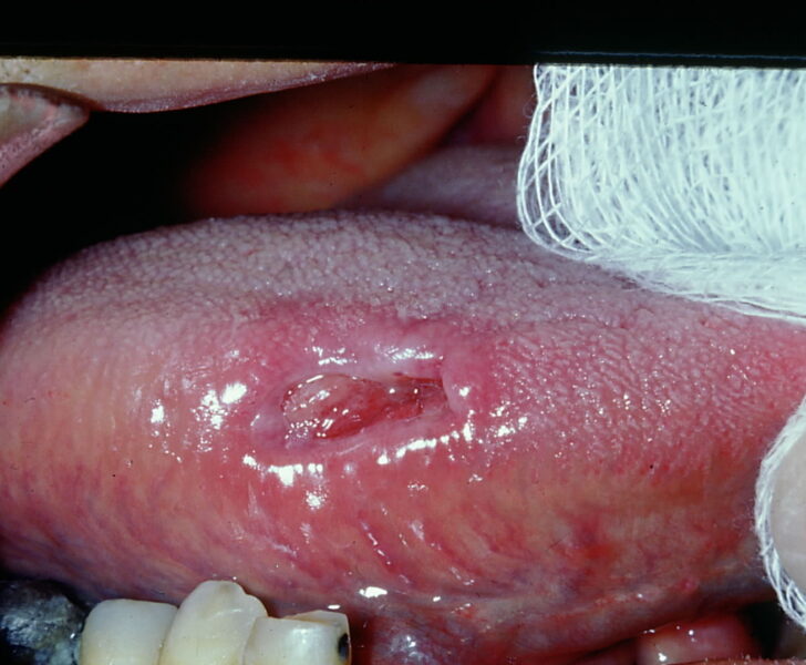 Traumatic ulcerative granuloma with stromal eosinophilia located on the tongue.