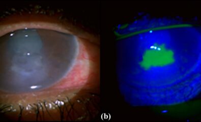 Clinical photograph of an eye with persistent corneal epithelial defect (b)Epithelial defect seen after fluorescein staining