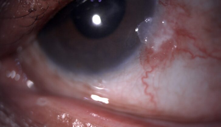 Slit lamp image of the patient depicting nasal whitish gelatinous conjunctivocorneal elevated plaque suggestive of ocular surface squamous neoplasia