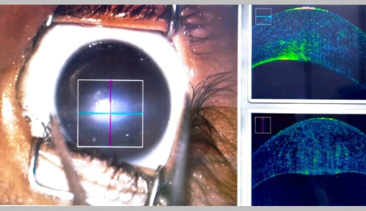 This is a clinical picture of the Peters anomaly a case, showing central corneal opacity with clear periphery. Anterior segment OCT shows increased corneal thickness.