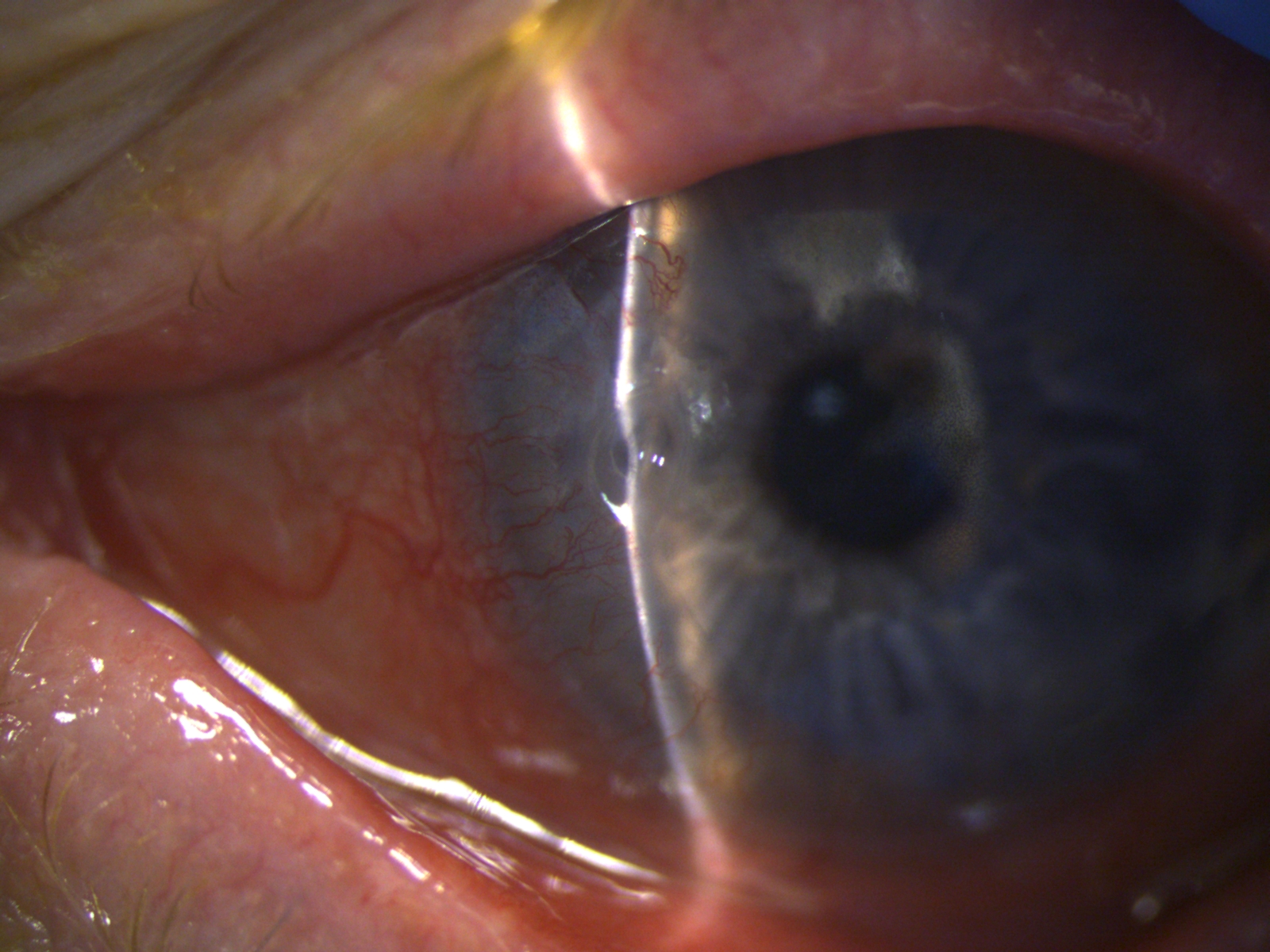 Peripheral Ulcerative Keratitis in Rheumatoid Arthritis. Note the signs of severe inflammation, such as scleral and corneal hyperemia and tearing, as well as corneal thinning, with the peripheral area appearing deformed and grayish.