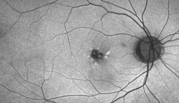 FAF with both increased and decreased autofluorescence corresponding to lipofuscin changes in butterfly pattern dystrophy.