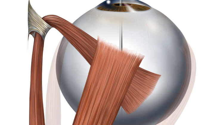 Superior Oblique Myomymia: Action of the Superior Oblique Muscle. The muscle changes direction via the trochlea which is a pulley-like structure and passes under the superior rectus muscle and inserts posteriorly and temporally on the globe. Muscle action causes intorsion and depression of the eye.