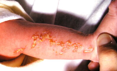 Infant with incontinentia pigmenti