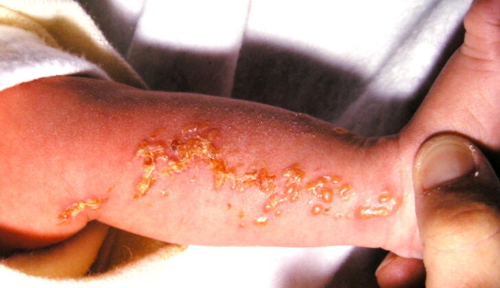 Infant with incontinentia pigmenti