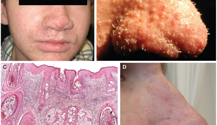 A. Leonine facial appearance, eyebrow alopecia, papules on nose, cheeks, chin, forehead and ears. B. Keratotic spicules and papules of nose. C. HE stain at 10x magnification, biopsy from affected forehead skin. Hyperplastic hair bulbs with distended infundibula and hypercornification. D. Nose 3 months post treatment with topical cidofovir treatment.