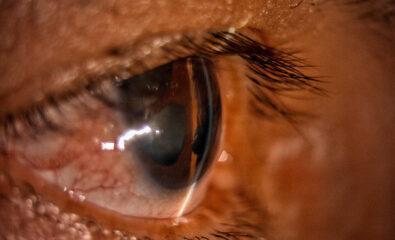 Iridocorneal Endothelial Syndrome: Secondary Angle-Closure Glaucoma. Slit-lamp biomicroscopy image of the shallow anterior chamber of the eye in a patient with iridocorneal endothelial syndrome suggestive of secondary angle-closure glaucoma.
