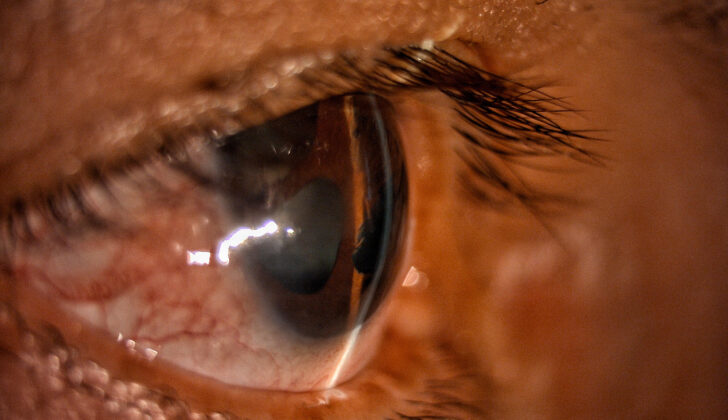 Iridocorneal Endothelial Syndrome: Secondary Angle-Closure Glaucoma. Slit-lamp biomicroscopy image of the shallow anterior chamber of the eye in a patient with iridocorneal endothelial syndrome suggestive of secondary angle-closure glaucoma.