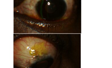 The Seidel test assesses for the occurrence of aqueous humor leakage through a defect in the integrity of the bleb. The image in the superior frame shows egress of aqueous from the anterior chamber through a thin fibrotic bleb occurring several years after trabeculectomy. This is made evident by the tracking of aqueous through the fluorescein stained ocular surface. In the lower frame, the image shows a cessation of aqueous leakage after revision of the bleb.