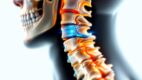 Cervical Disc Injuries