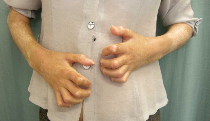 Bilateral Signs of Raynaud Phenomenon in a Patient's Hands. A male patient is exhibiting triphasic color changes in the digits of his hands, indicative of Raynaud Phenomenon.