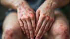 Dermatitis Herpetiformis
