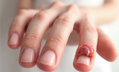 Digital Mucous Cyst (Benign Soft Tissue Tumor Found Next to a Joint or Tendon)