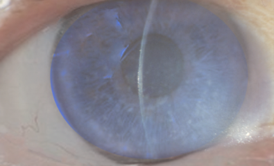 Fuchs endothelial dystrophy
