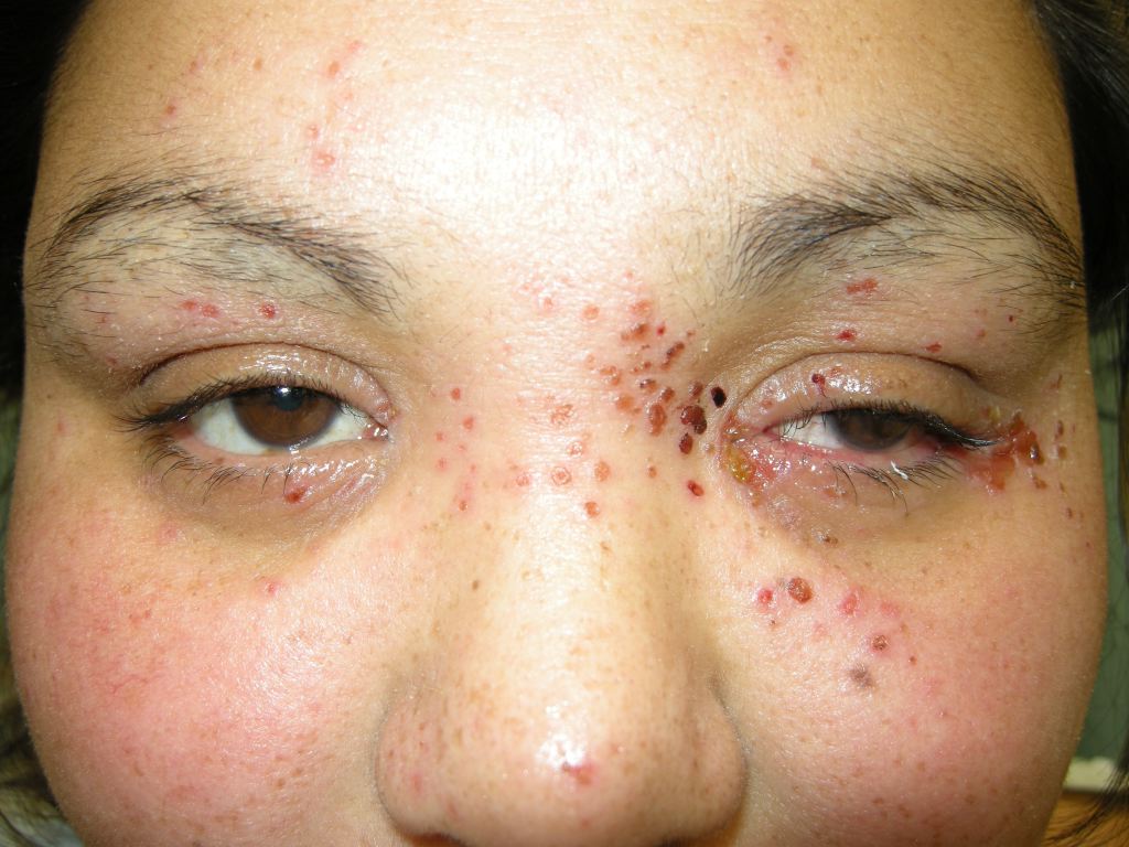 Eczema Herpeticum