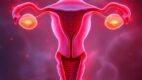 Endometritis