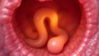 Epiphrenic Diverticula (Distal Esophageal Diverticulum)