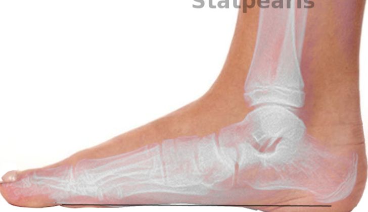Progressive Collapsing Foot Deformity. A complex pathology defined by the collapse of the medial longitudinal arch of the foot with continued progressive deformity of the foot and ankle.