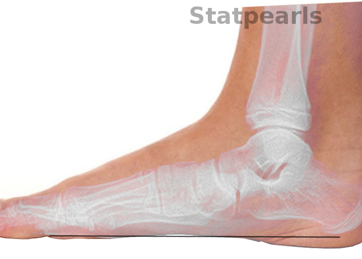 Progressive Collapsing Foot Deformity. A complex pathology defined by the collapse of the medial longitudinal arch of the foot with continued progressive deformity of the foot and ankle.