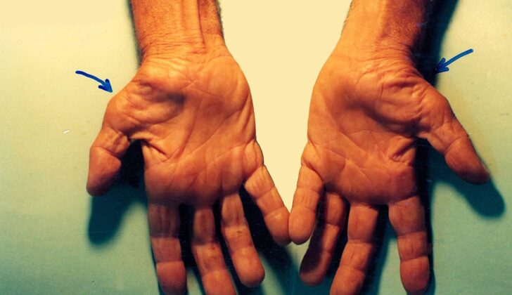 Untreated Carpal Tunnel Syndrome