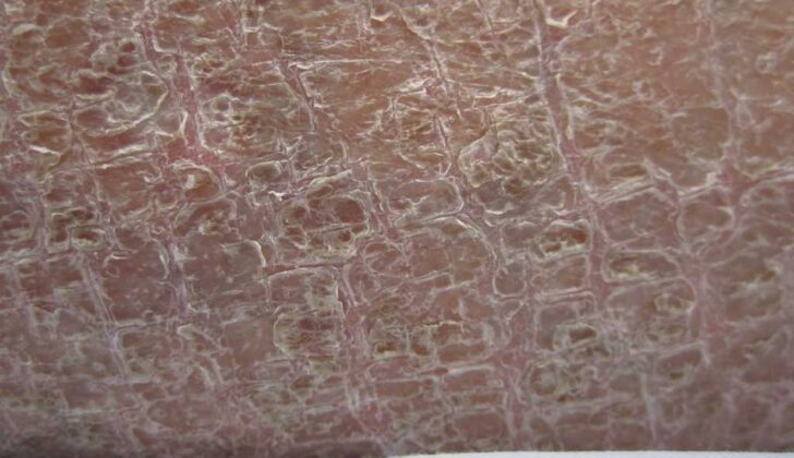Ichthyosis