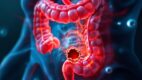 Intestinal Perforation