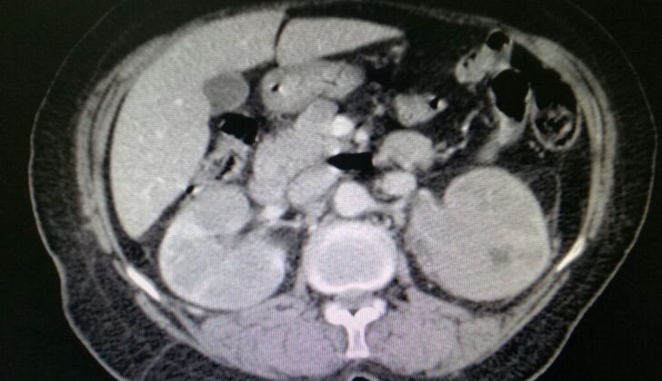 Bilateral multinodular renal presentation of disseminated non Hodgkin disease seen on post contrast CT scan