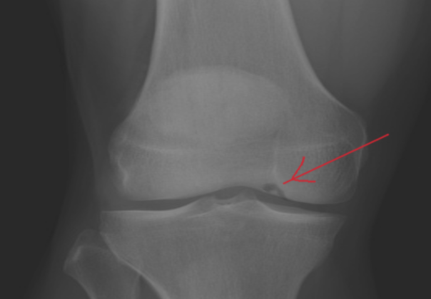 Osteochondritis dessicans