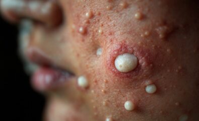 Kyrle Disease