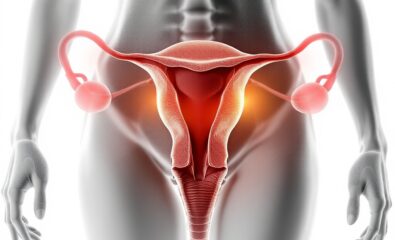 Leiomyoma (Uterine Fibroids)