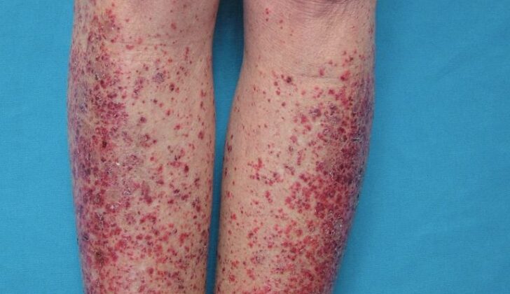 Leukocytoclastic Vasculitis