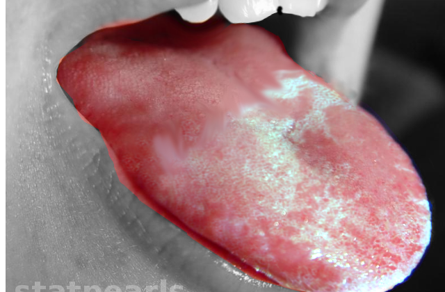 Oral leukoplakia is a condition characterized by white patches or plaques that develop on the mucous membranes of the mouth, often caused by tobacco use.