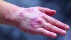 Lichen Planus