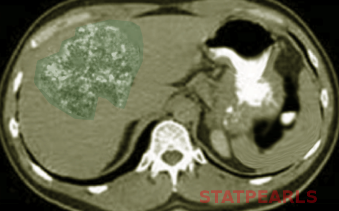 Liver angiosarcoma