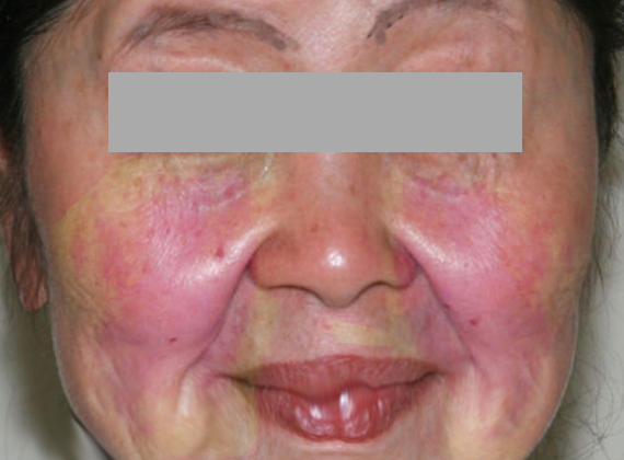 Lupus pernio is a chronic skin condition characterized by purple or red lesions on the nose, cheeks, ears, and fingers, often associated with sarcoidosis.