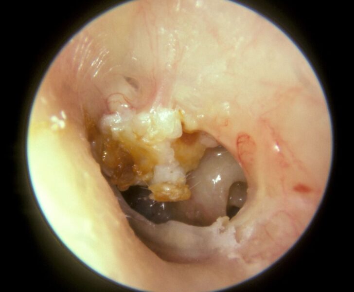 Cholesteatoma in the Left Tympanic Membrane. A large mass of white keratin debris is visible in the left upper quadrant of the left tympanic membrane, indicating a cholesteatoma. The majority of the tympanic membrane is missing due to perforation. In the lower right quadrant, the round window niche on the medial wall of the middle ear is visible.