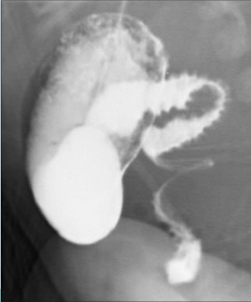 Abnormal C-Loop and Corkscrew Appearance of Jejunum. A midgut volvulus is a medical condition where the intestines twist upon themselves, which can occur at any age. However, it is more frequent in children and infants.
